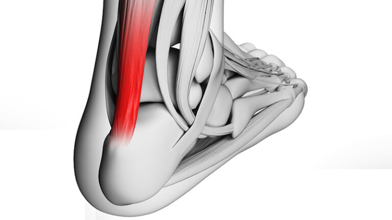 couper talon chaussure running tendinite du tendon d'Achille